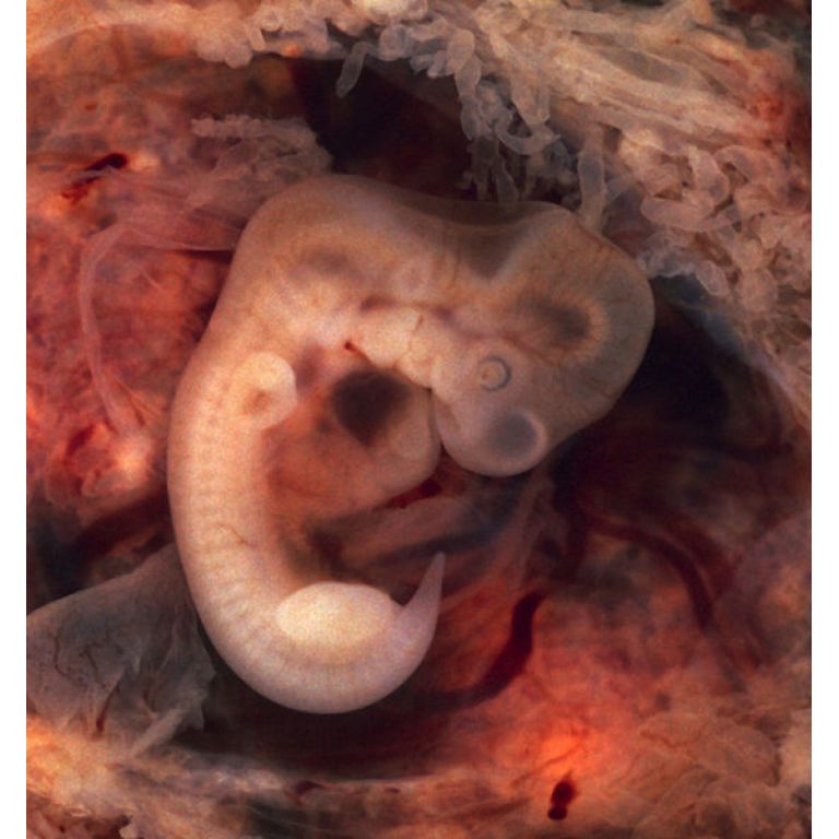 Nace beb a partir de embrin congelado durante 20 aos